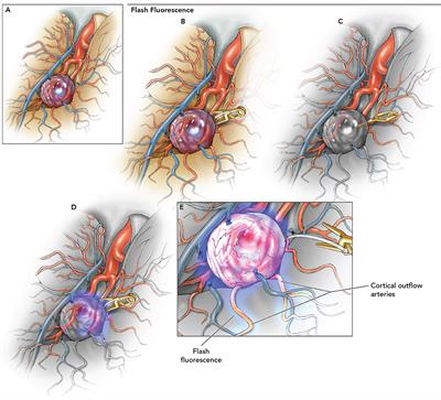 Applications of Microscope-Integrated Indocyanine Green Videoangiography in Cerebral Revascularization Procedures